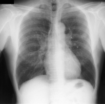 chest x-ray gan thumbnail